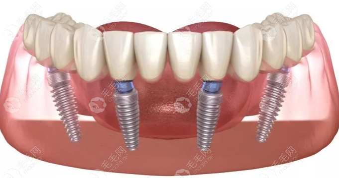 全口牙缺失种植方案:含满口假牙的种类及价格详细介绍