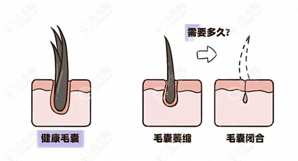 从脱发、毛囊萎缩到闭合要多久,教你如何判断毛囊是否闭合