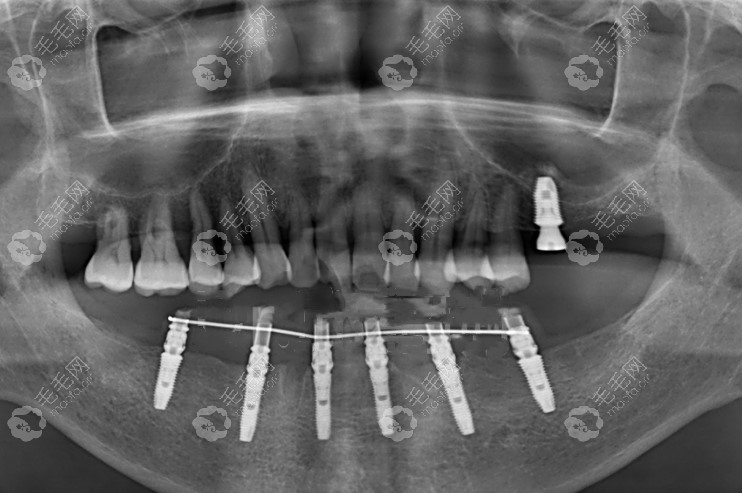 allon6登腾半口种植牙ct照片