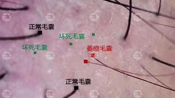 毛囊檢測(cè)直接看毛囊是否萎縮閉合
