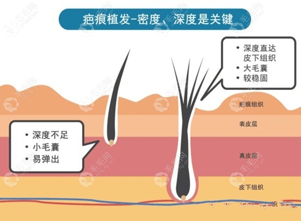 疤痕植发技术注意点