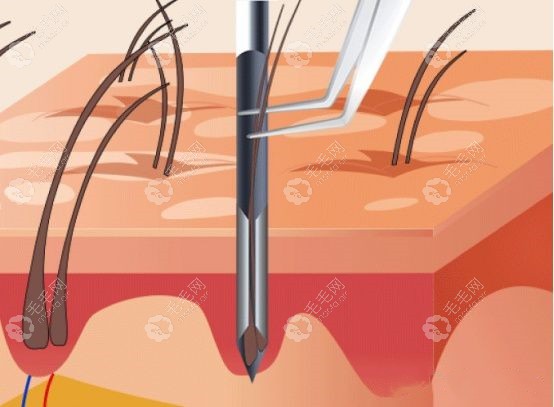 新微针植发和传统微针植发的区别在哪?它们植发一单位差2元