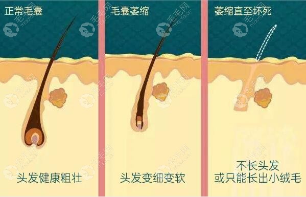 如何判斷毛囊是否萎縮閉合