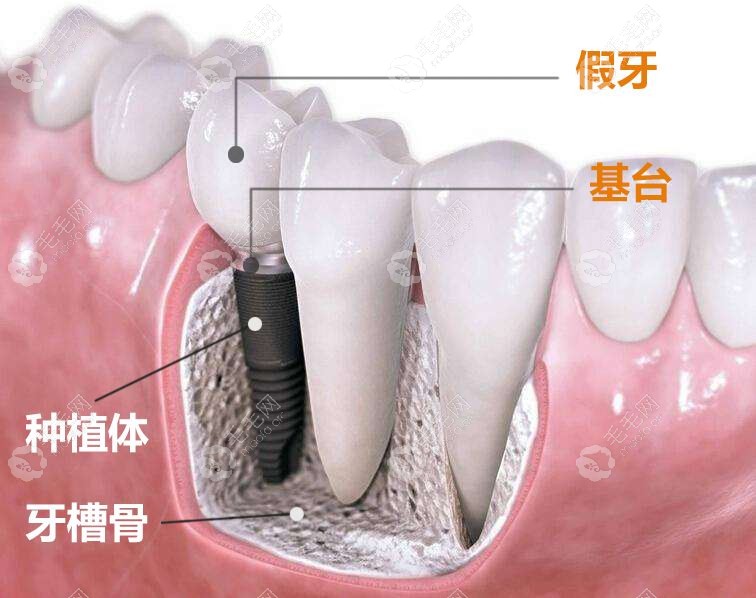 种植牙结构示意图