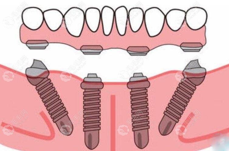 all-on-4种植牙修复