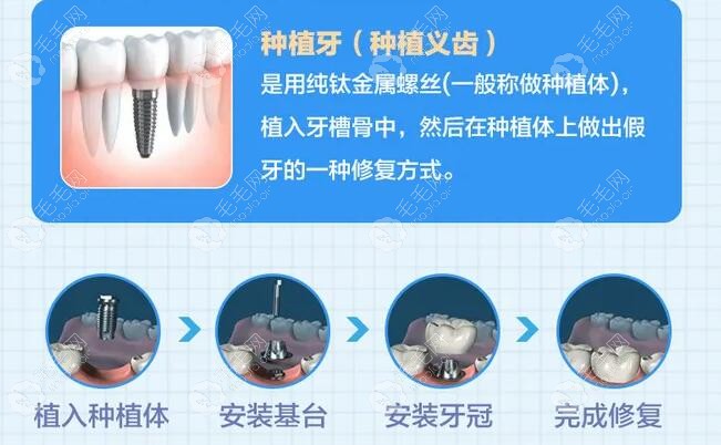 種植牙的詳細(xì)流程步驟