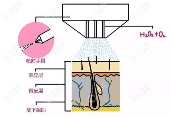 植发医院水氧光疗