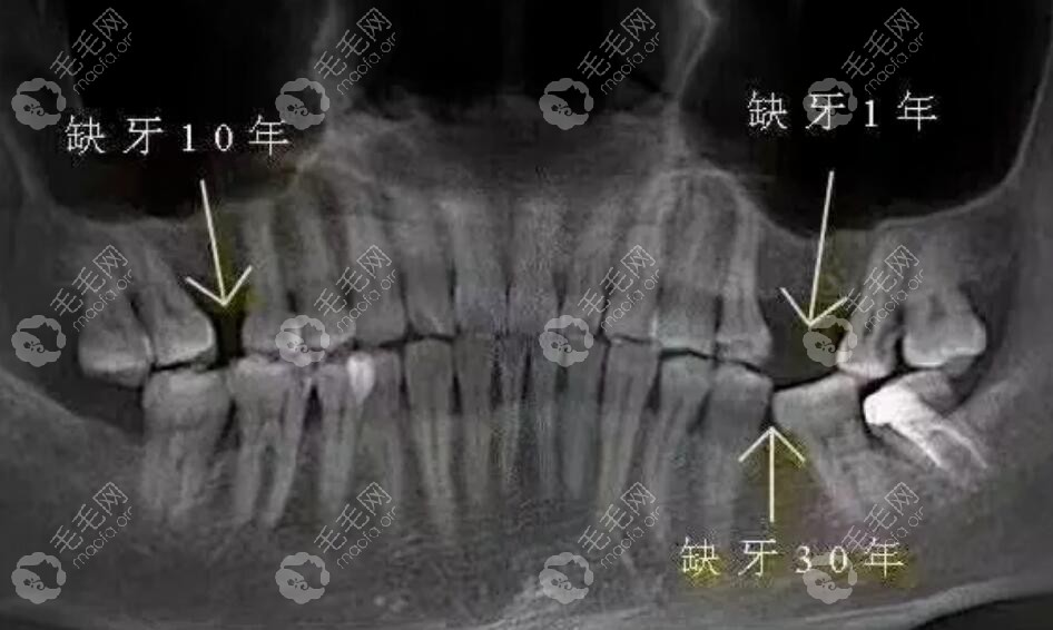 缺牙后多长时间不能做种植牙