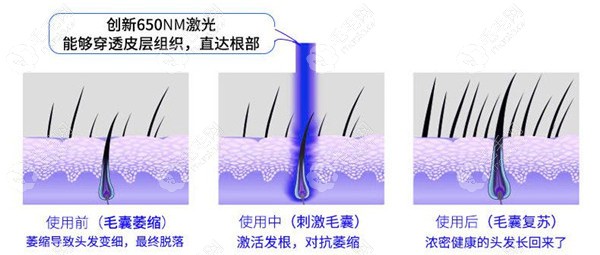 激光生发的作用机理