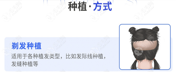 后枕部整片剃发示意图