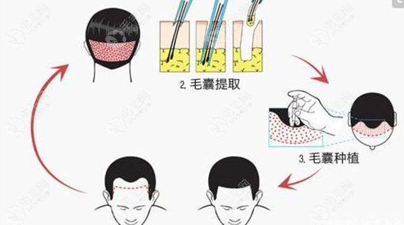 sht植发技术原理示意图