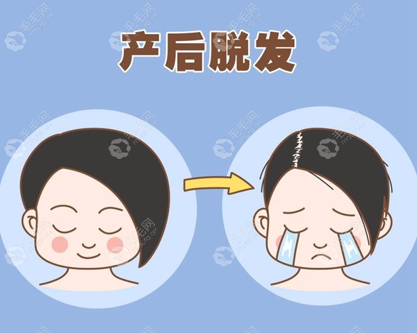 产后脱发是激素水平的影响