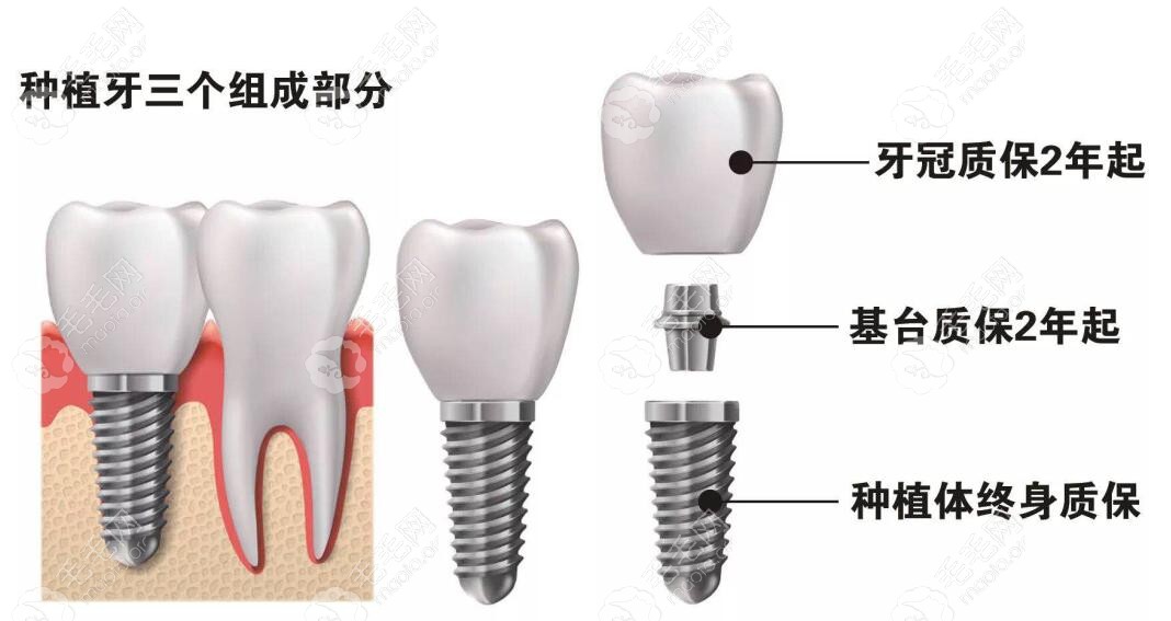 种植牙保修10年和保修终身的区别