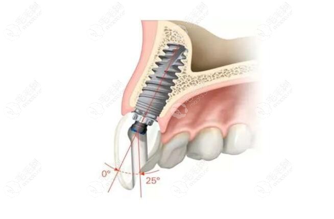 前牙种植角度问题