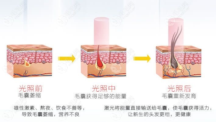 308准分子激光治疗斑秃的原理