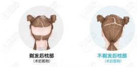 不剃发技术植发的较低开台费来啦,想知道开台费会单独收吗?