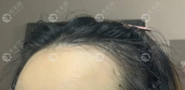 天生的发际线高用龙卷风670nm激光生发仪有效吗