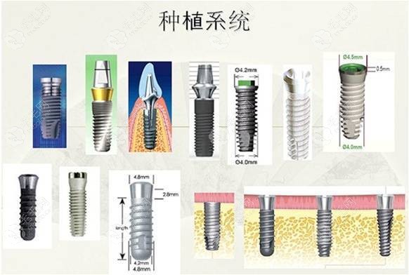 韩国种植牙哪几个品牌性价比高?主要指使用寿命长还便宜