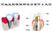 解答:高血压脑梗做种植牙有什么风险和后遗症