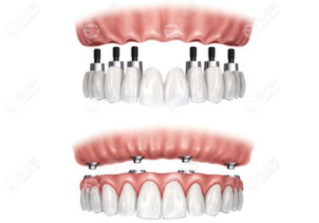 全口种植牙示意图