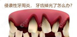 侵襲式牙周炎導(dǎo)致牙都掉光了?全口義齒和種植牙都可挽救你
