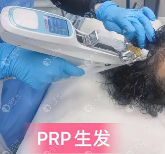 [价格篇]在头皮注射prp生发治疗脱发一次多少钱?上费用报价