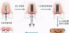 固定种植牙的螺丝钉子会生锈吗?纯钛材料的种植体当然不会