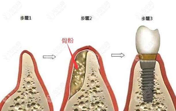 牙槽骨过薄也可以通过植骨解决