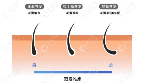 天生自然卷可以植发，但是取发难度大