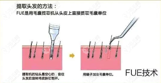 FUE3.0植发技术价格