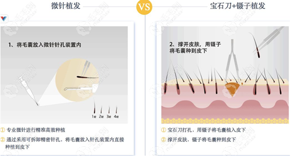 头顶加密选fue植发好还是微针好