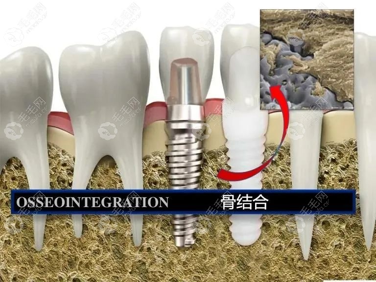 牙槽骨不够需要先进行植骨手术