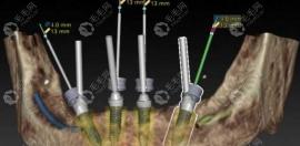 这有半口即刻负重种植牙的流程图及原理,牙槽骨萎缩者必看