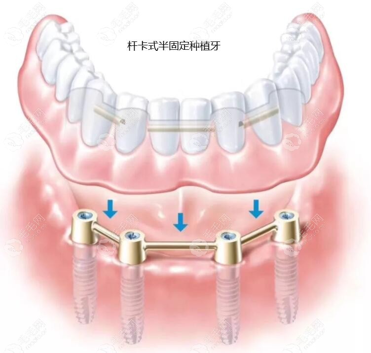 杆卡式半固定种植牙