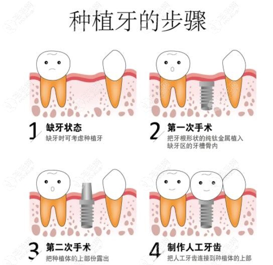 种植牙的过程步骤及视频分享,单颗和全口种植流程差不多哦