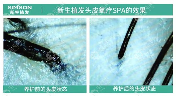 新生做头皮氧疗SPA前后对比