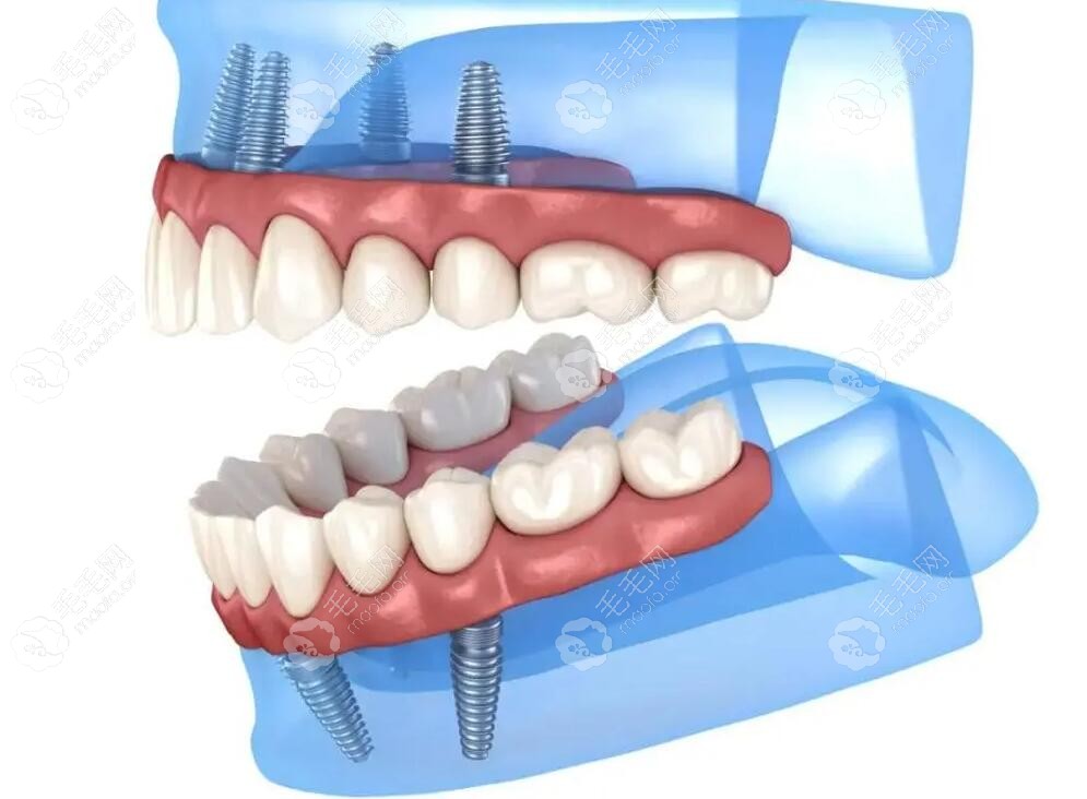 全口种植牙模拟图