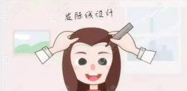 湖北武汉一般发际线植发多少钱,武汉发际线植发咨询篇来啦