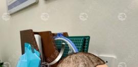 4000单位植发属不属于大面积植发,植发4000单位对应面积多大