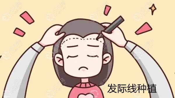 发际线种植