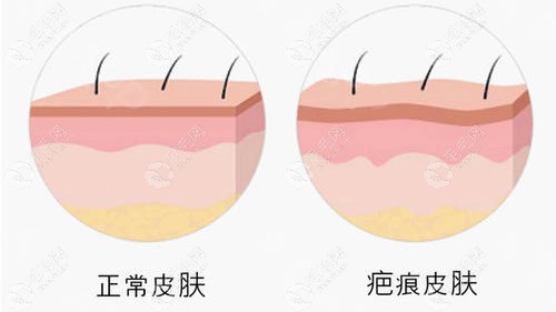 疤痕修复植发比一般植发手术难度高