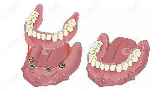全口种植覆盖义齿