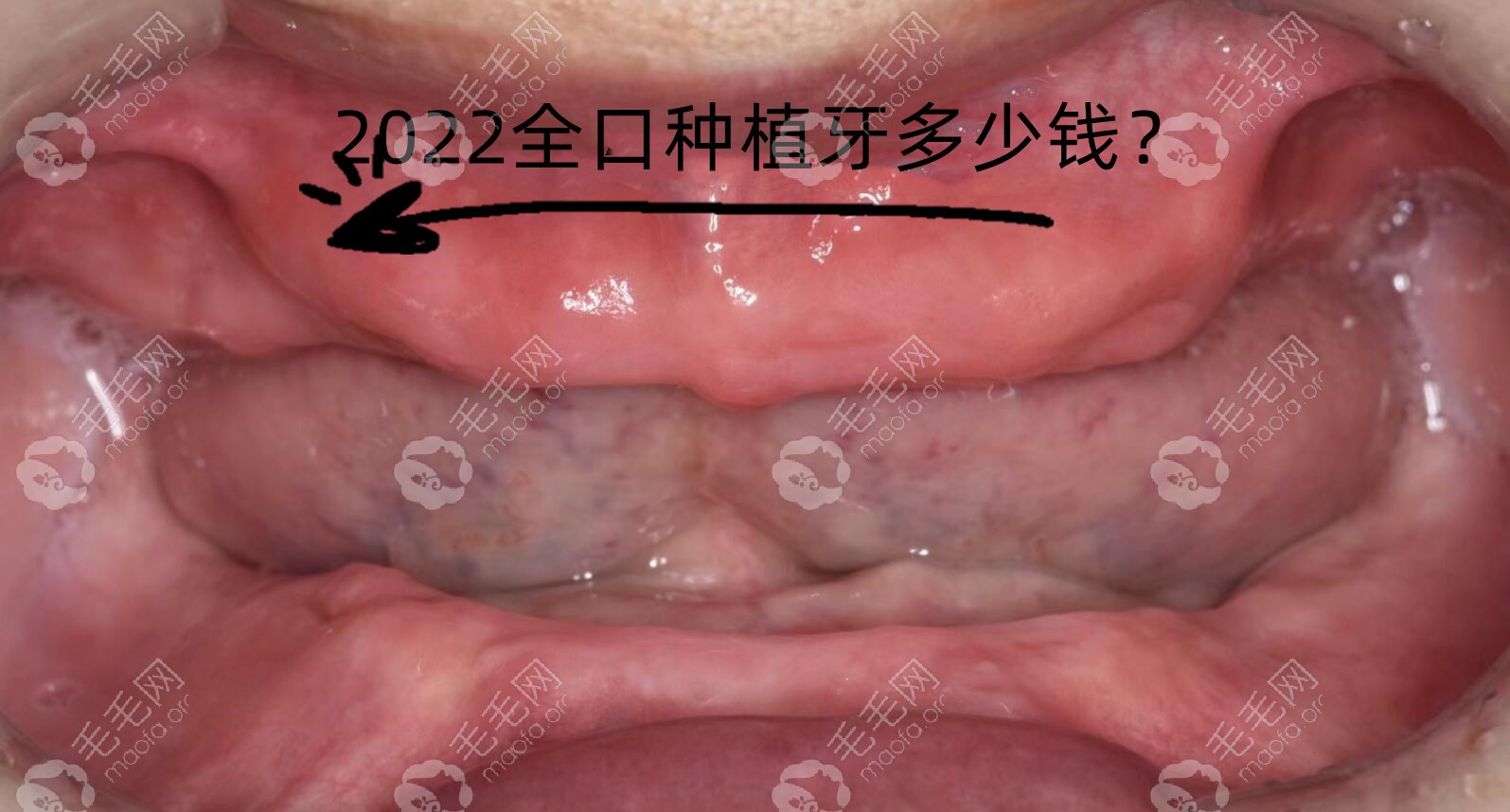 2022种植全口牙到底多少钱？和2021种植牙价格比下降幅度大吗
