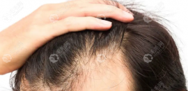 发际线没有呈裸区需要种植吗?朋友建议做加密植发55的密度