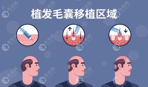 为什么疫情期间很多人植发?很多人是因为它选择现在植发的