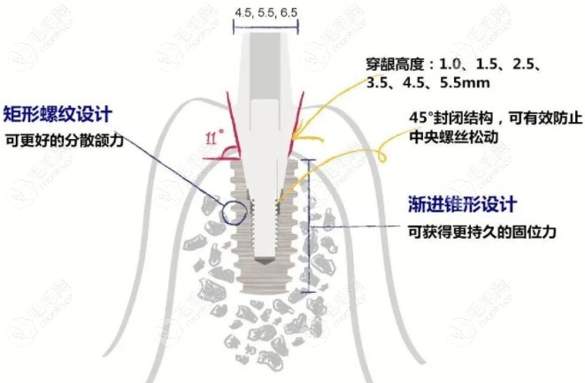 仕诺康种植体设计优势二