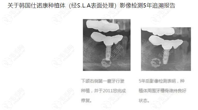 做了韩国仕诺康种植牙后5年影响报告对比