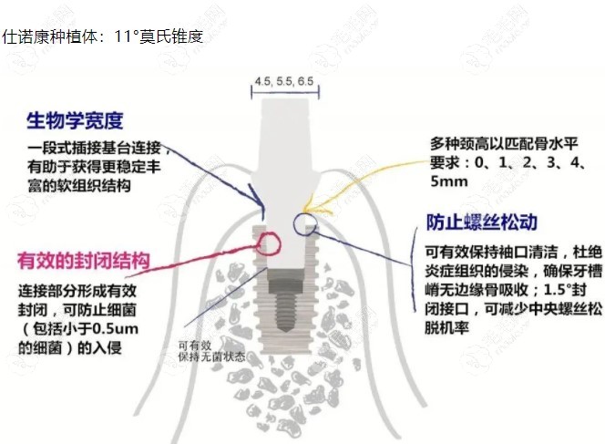 仕诺康种植体设计优势