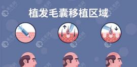 为什么疫情期间很多人植发?很多人是因为它选择现在植发的