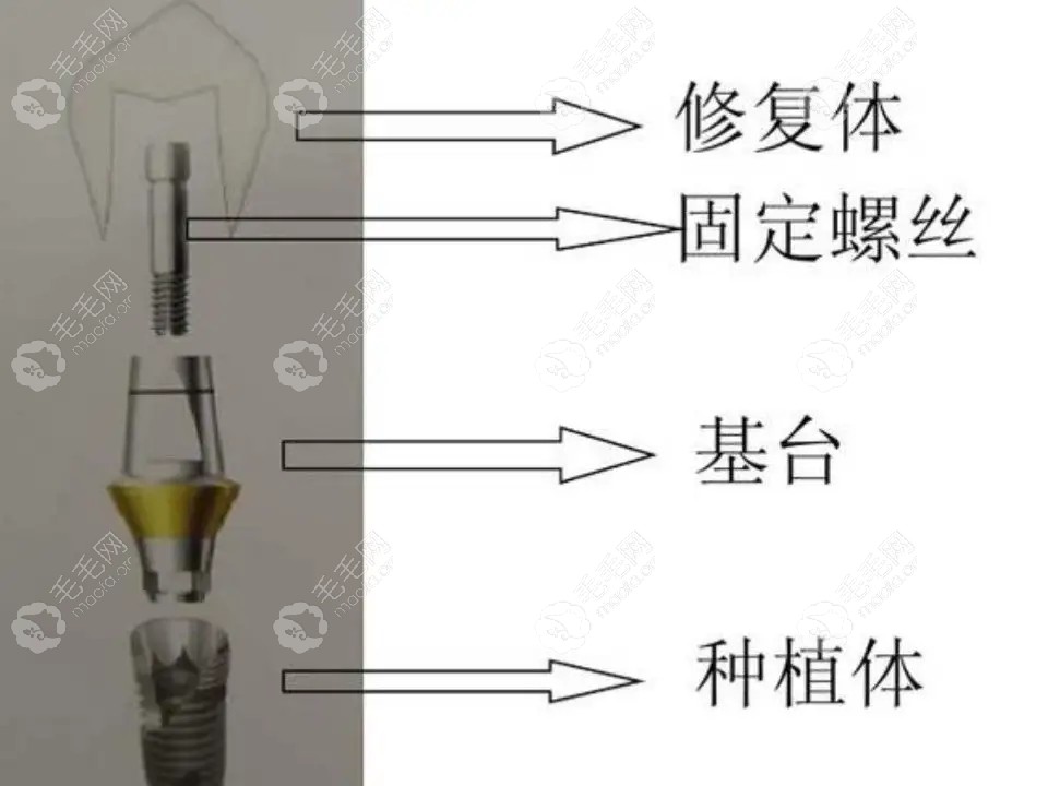 种植牙愈合基台掉了怎么办?愈合基台脱落后的注意事项须知